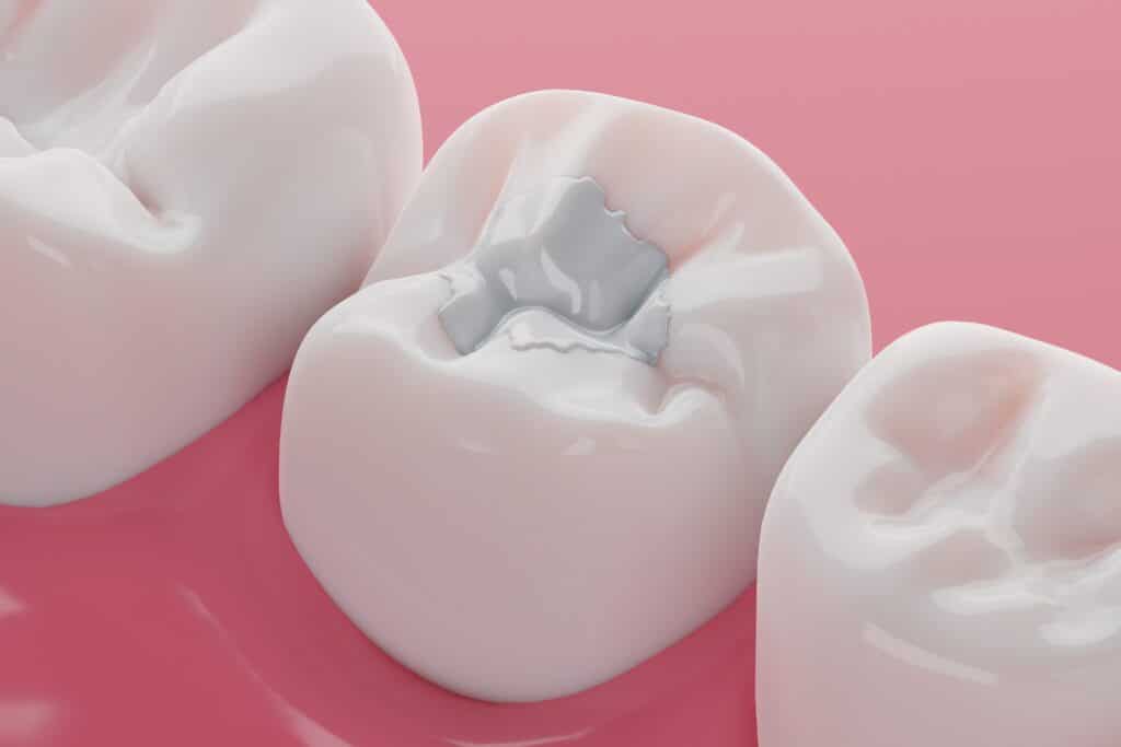 Molar tooth with dental filling on pink gum