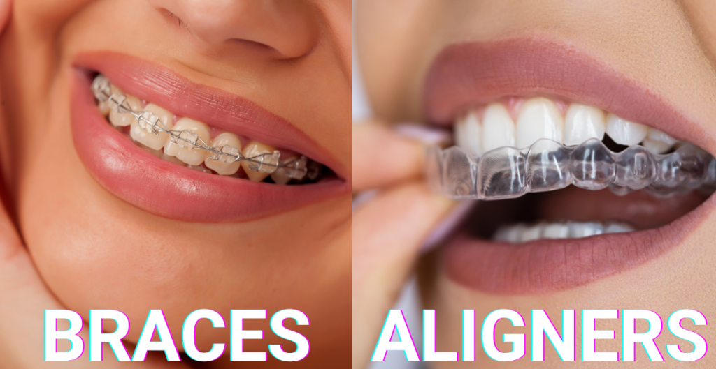 Clear Aligners vs Braces in Kissimmee: Choosing the Right Orthodontic Treatment for You