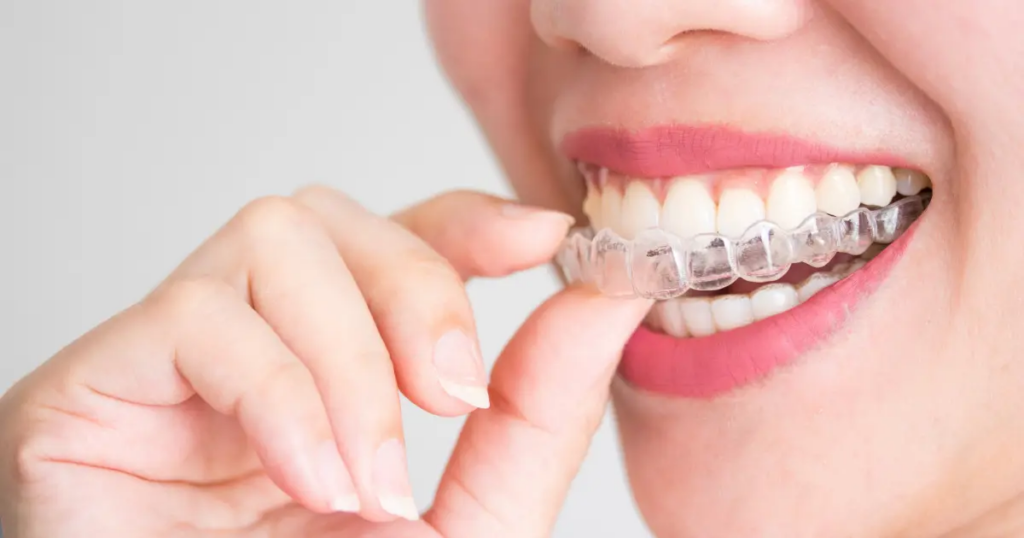 Clear Aligners for Adults: A Comprehensive Guide to Treatment in Kissimmee