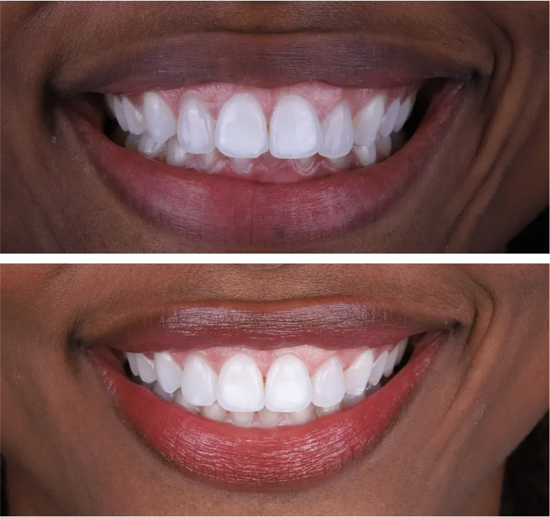 Clear Aligners Before and After: Real Smile Transformations with Kissimmee's Best Invisible Braces