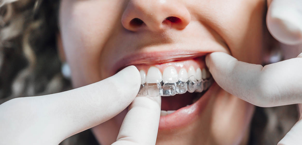 How Do Clear Aligners Work? A Step-by-Step Guide to the Clear Aligner Process and Teeth Movement