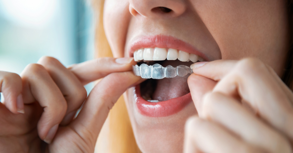 Are Clear Aligners Worth It? Comprehensive Pros, Cons, and Patient Insights in Kissimmee
